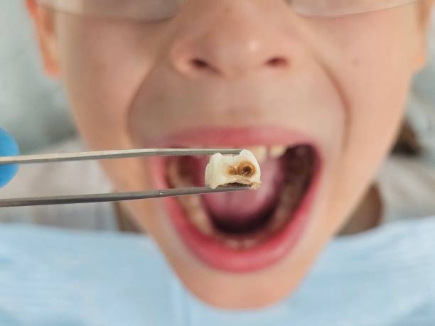 Best Dental Abscess Treatment in Pompton Plains, NJ
